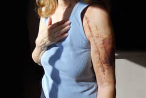 Scarring and Disfigurement Attorney in Glendale AZ